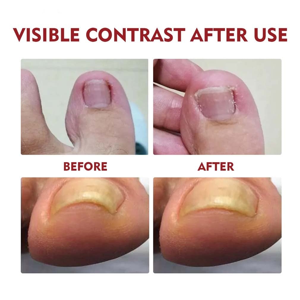 Relief Nail Oil – Extra Strength Care for Discolored & Damaged Nails