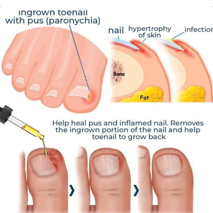 Relief Nail Oil – Extra Strength Care for Discolored & Damaged Nails